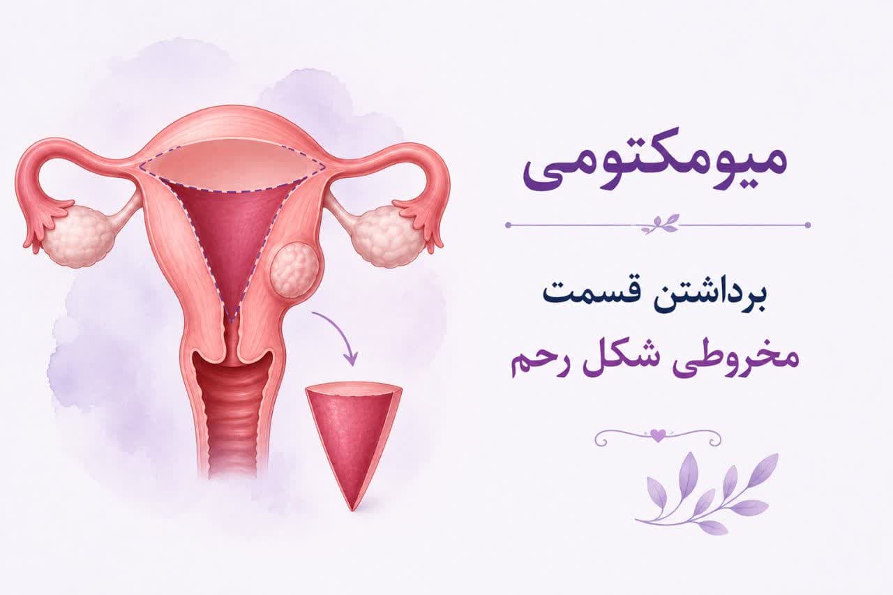 برداتشن قسمت مخروطی شکل رحم (میومکتومی ) - جزوه آموزشی