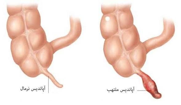 عمل آپاندیسیت (فایل صوتی)